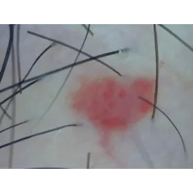 Dermatoskop Dino-Lite (VideoDermatoskop)