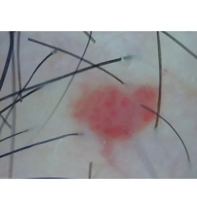 Dermatoskop Dino-Lite (VideoDermatoskop)