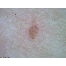 Dermatoskop Dino-Lite (VideoDermatoskop)