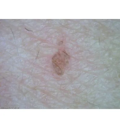 Dermatoskop Dino-Lite (VideoDermatoskop)