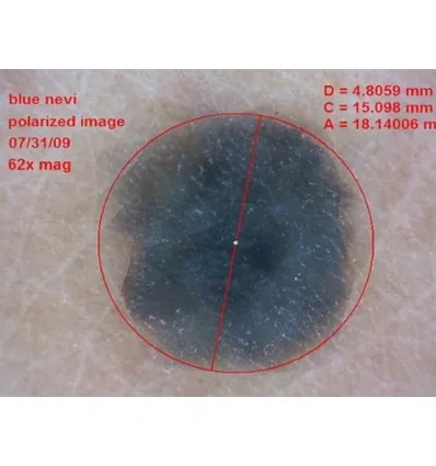 Dermatoskop Dino-Lite (VideoDermatoskop)